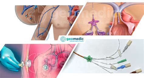 Los Mejores Cat Teres Venosos Centrales En Venta Geomedic