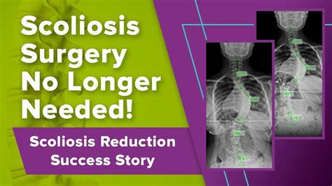 Scoliosis Surgery No Longer Needed Scoliosis Reduction Success Story