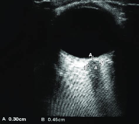 Measurement Of Optic Nerve Sheath Diameter In Ultrasonography Download Scientific Diagram