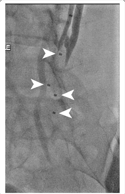 Final Case Image Showing Acute Occlusion Of The Vessels With Two