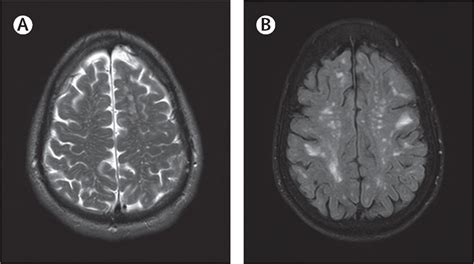 The Boston Criteria Version 20 For Cerebral Amyloid Angiopathy A