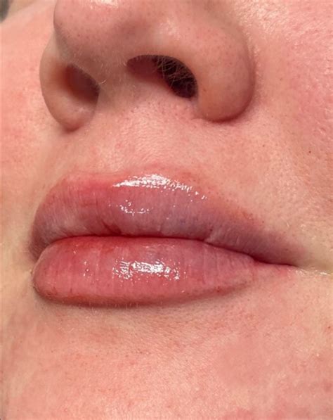 Dermal And Lip Filler Archives Image Surgical Arts