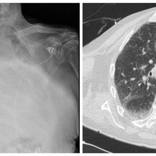 December 17th Imaging Pre Left And Post Right Bronchoscopy