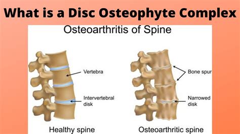 What Is A Disc Osteophyte Complex Youtube