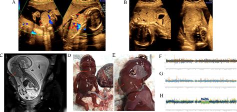 Teratoma Twin