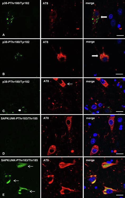 Dysregulated Protein Phosphorylation As Main Contributor Of