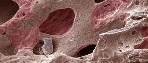 Guided Bone Regeneration With A Gelatin Layer And Adenoviral Delivery 69F