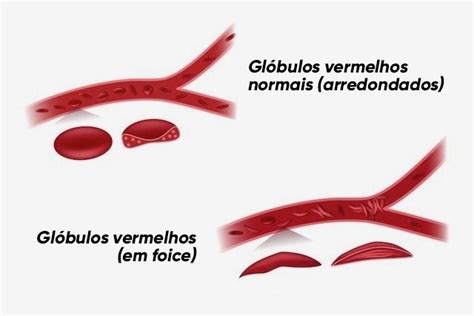 Anemia Falciforme O Que Sintomas Causas E Tratamento Tua Sa De