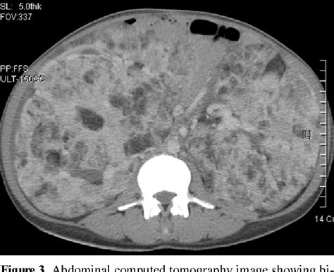 Figure From A Case Of Pulmonary Lymphangioleiomyomatosis Associated