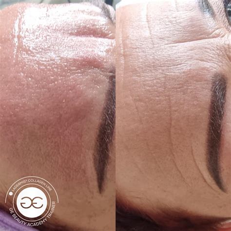 Collagen Faden Lifting Ohne Op Chemnitz Schulung