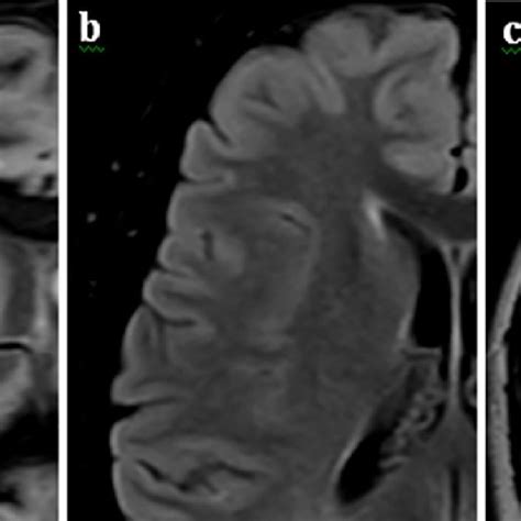 36 Year Old Male With Spms Presented Diplopia With An Intracortical Download Scientific Diagram