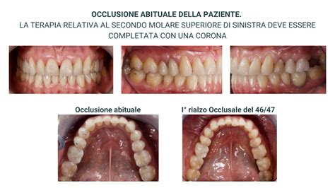 Vertigini Disturbi Dell Equilibrio Soluzione Doppio Rialzo Occlusale