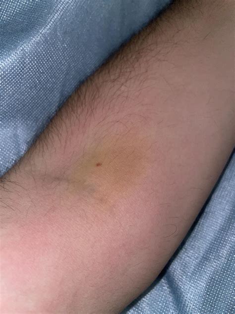 Blood Clot In Arm After Iv