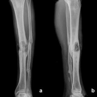 Antero Posterior A And Lateral B Radiographs Show Ill Defined