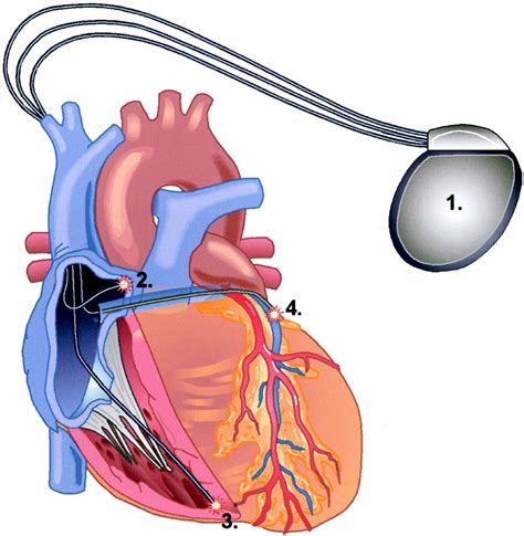 Cardiac Resynchronization Therapy Circulation