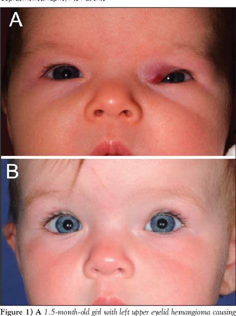 Table 1 From Beta Blockers For The Treatment Of Problematic Hemangiomas