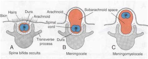 Spina bifida occulta - myDr.com.au