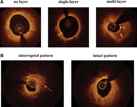 Sex Differences In Coronary Atherosclerotic Phenotype And Healing Pattern On Optical Coherence