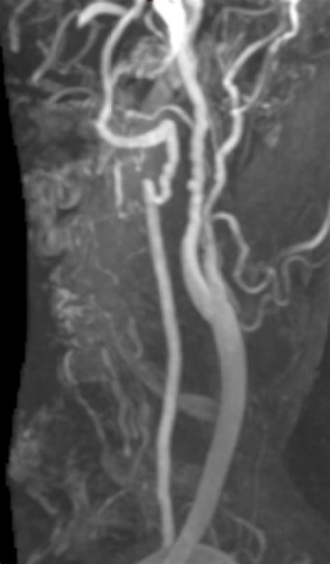 Fibromuscular Dysplasia Of The Carotid Artery Mra Radrounds Radiology Network