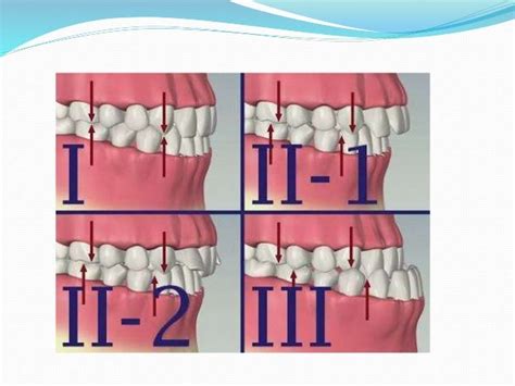 Classification Of Malocclusion