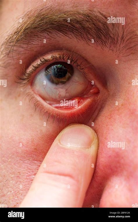 Closeup Macro Man With Stye Hordeolum Bacterial Eye Infection Inside