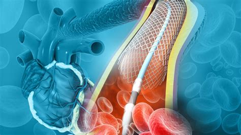 Chances Of Receiving Percutaneous Coronary Intervention In A Low Volume