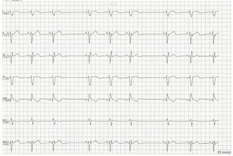 Sinus rhythm with dropped PACs