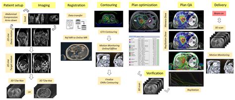 Cancers Free Full Text Mri Guided Online Adaptive Stereotactic Body Radiation Therapy Of