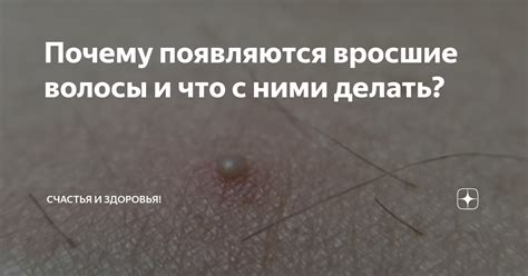 Почему появляются вросшие волосы и что с ними делать? | Треды! | Дзен