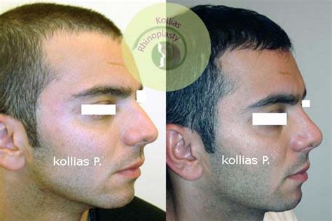 Rhinoplasty With Disfunctional Nasal Valvid 011 Π Κόλλιας