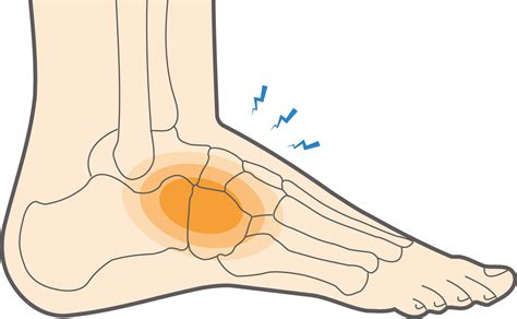 What is a Midfoot Sprain & How to Address This Foot Injury? - Upswing Health