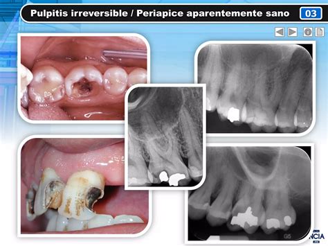 Diagnostico Pulpar Y Periapical Ppt