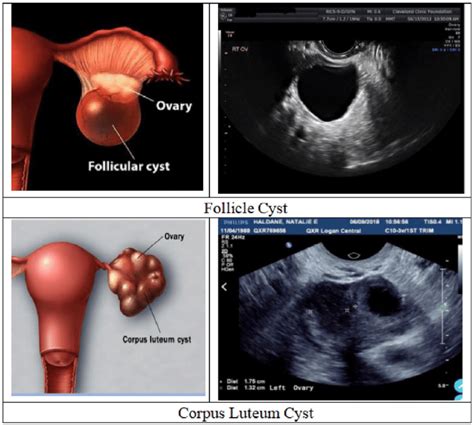 Ovarian Cysts Ovarian Cancer Pictures