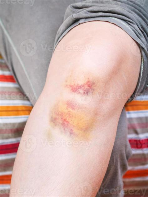 Knee Injury Bruise On Leg 11849785 Stock Photo At Vecteezy