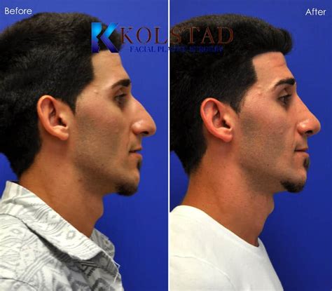 Nasal Tip Ptosis Nose Job For Men Before And After Gallery 19 Dr