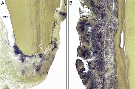 Histobacteriologic Conditions Of The Apical Root Canal System And