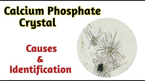 Calcium Phosphate Crystals In Urine
