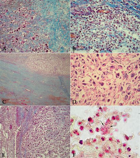 A Granulation Tissue A The Granulation Tissue Illustrates Bizarre Download Scientific Diagram