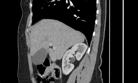 Annular Pancreas Radiopaedia B Nc Commons