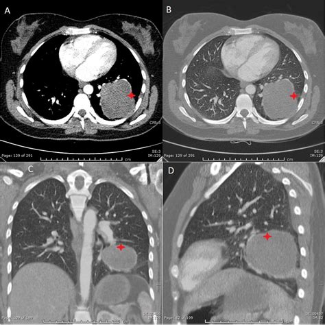 Figure From The Radiologic And Pathologic Diagnosis Of Biphasic