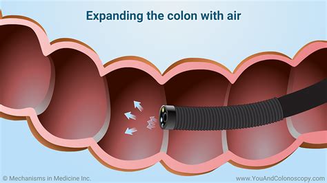 What Happens During And After A Colonoscopy