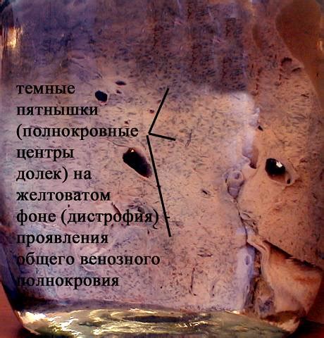 «Ожирение сердца».