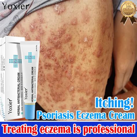 Yoxier Eczema Psoriasis Ointment 20gnatural Cream For Itching Skin Can