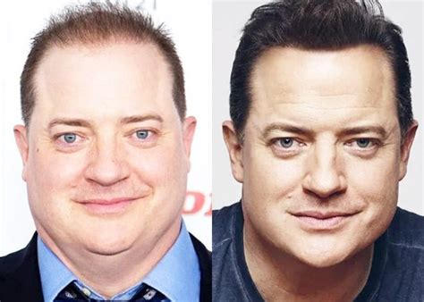 Brendan Fraser Hair Transplant