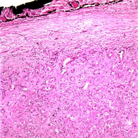 Bile Duct Adenoma Basicmedical Key