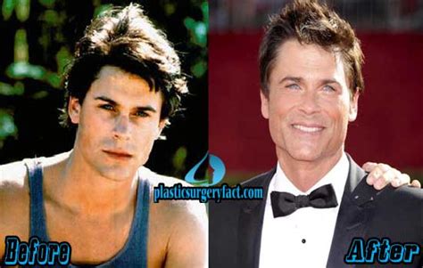 Rob Lowe Plastic Surgery Before And After