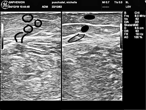 Saphenion Krampfader Therapie Mit Venenkleber