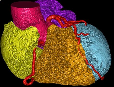 Ai Enhanced Heart Ct Image Eurekalert Science News Releases