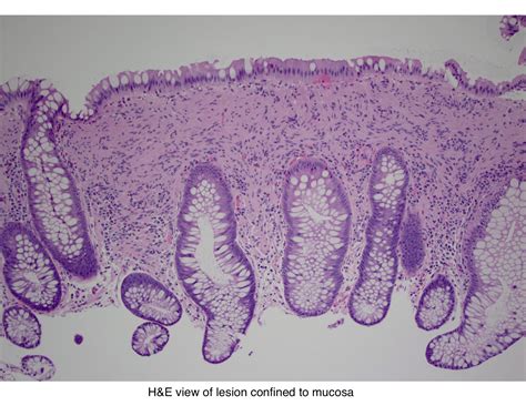 Pathology Outlines Mucosal Schwann Cell Hamartoma