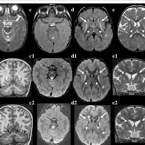 Magnetic Resonance Imaging Scans Of Patient 3 Sagittal T1 Weighted